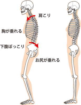腰痛や肩こりなどの原因になる姿勢の骨格図