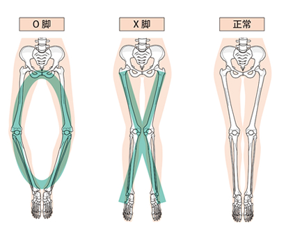 O脚・X脚・正常な足の骨格図